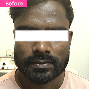 Chemical Peel Treatment Before Image